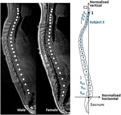 The Effect of Seat Back Inclination on Spinal Alignment in Automotive Seating Postures